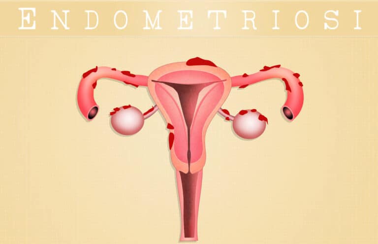 Cosa è l'endometriosi