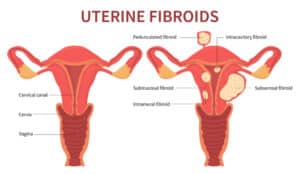 immagine di utero con fibromi